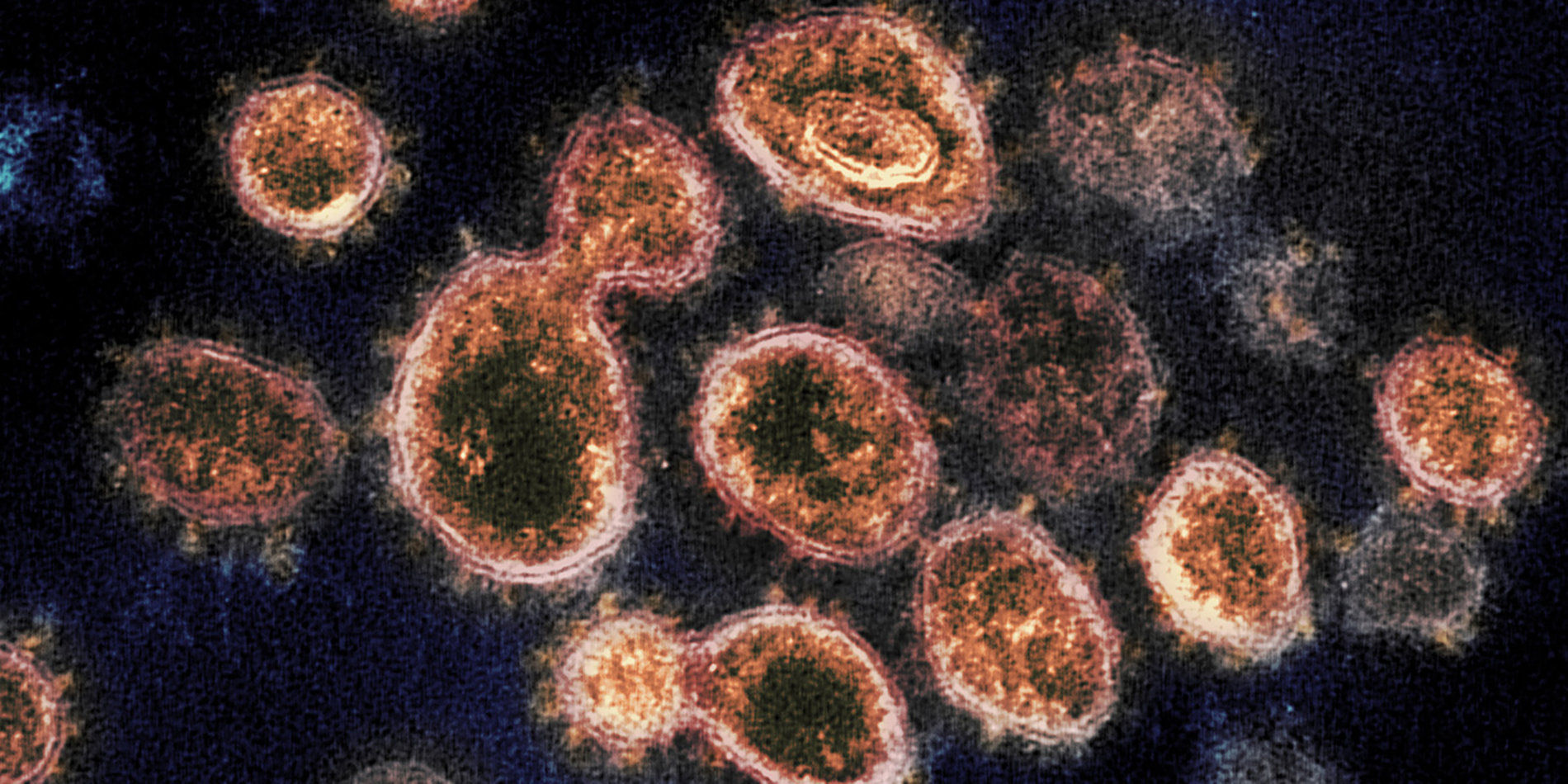 
A transmission electron microscope image shows SARS-CoV-2, the virus that causes COVID-19. | Flickr/NIAID-RML