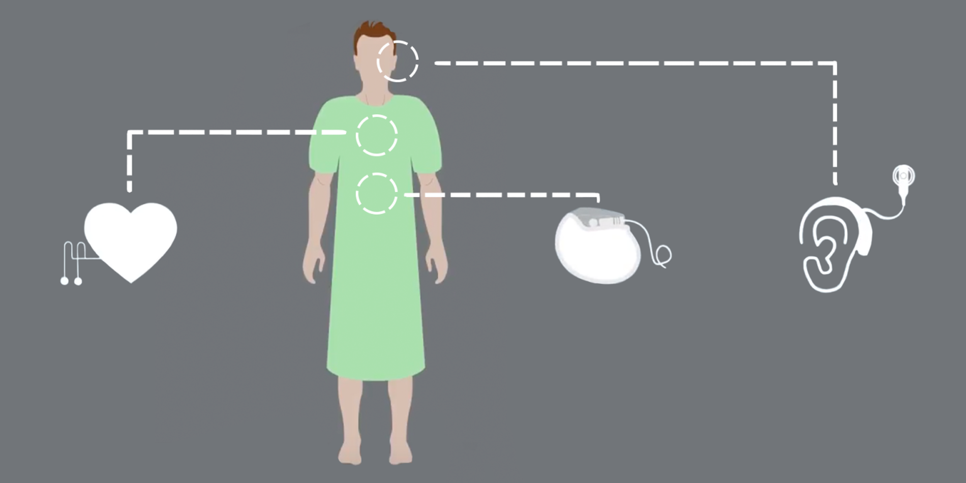 
Researchers are developing wireless implants that can monitor organs such as the heart, kidney and ear drum. | Illustration by Stefani Billings