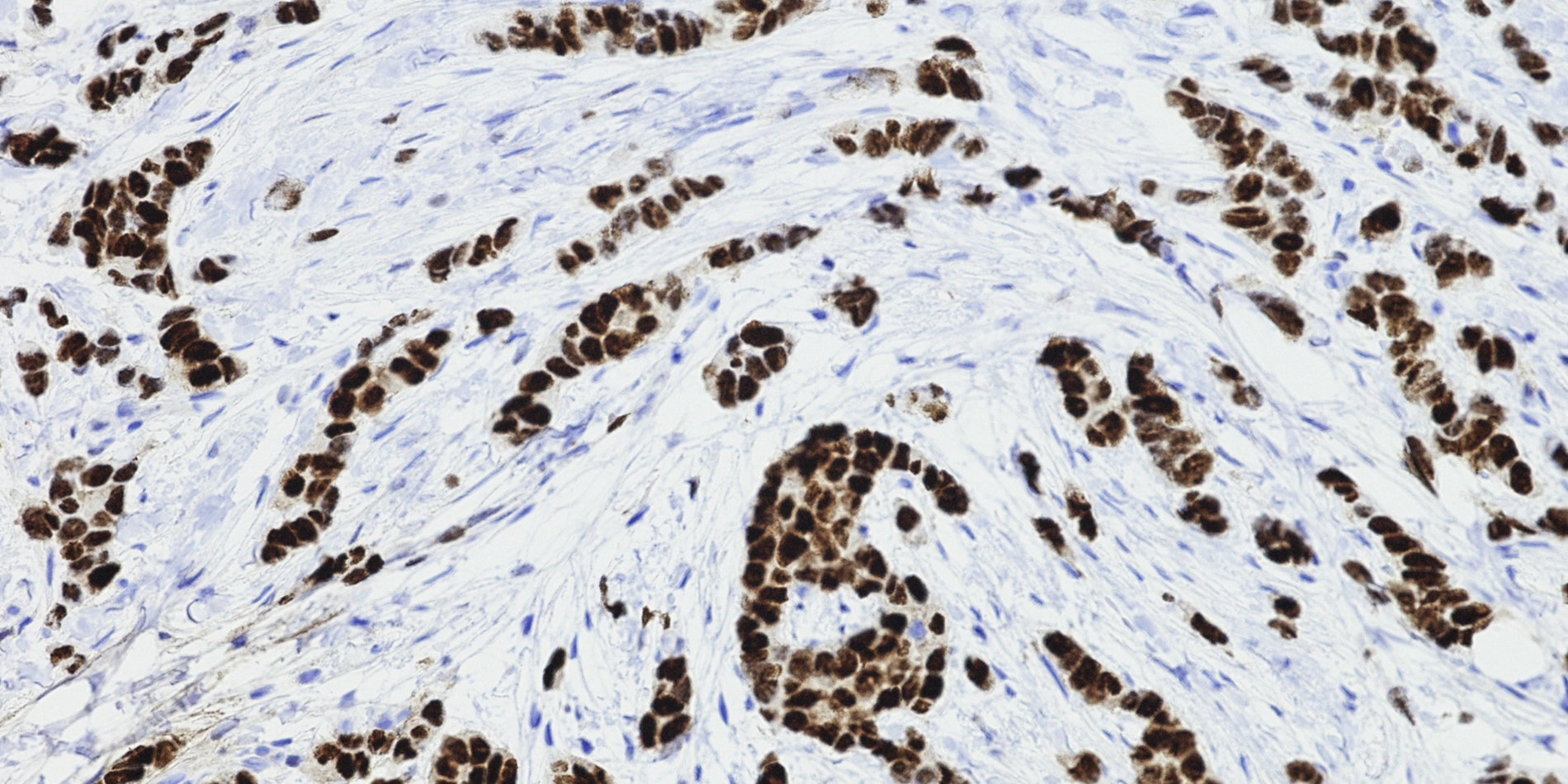 
Invasive lobular carcinoma of the breast. | iStock/OGphoto