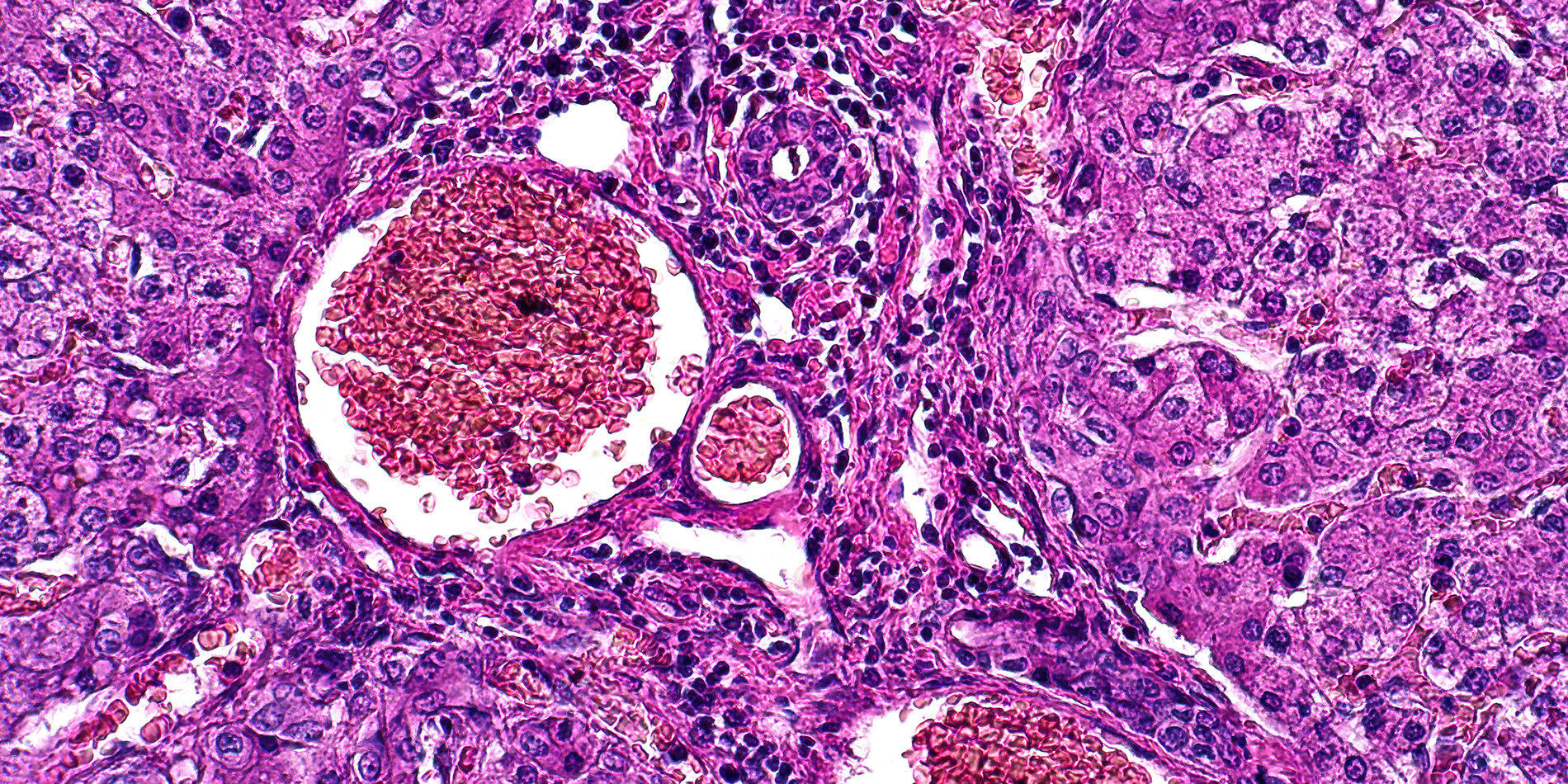 Photo of liver pathology under a microscope.