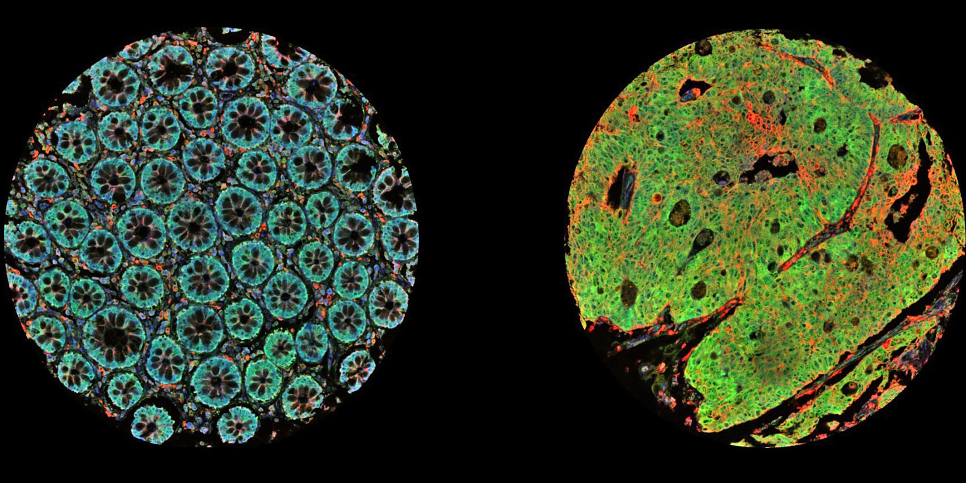 Colorful, circular cross-sections of microscopic cancer cells. 