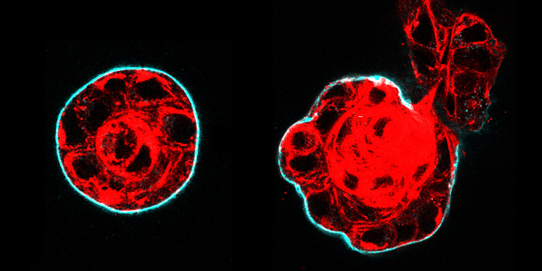 Side-by-side images of a breast milk duct showing the transition from non-invasive to invasive cancer, with cells in red and the basement membrane in blue.